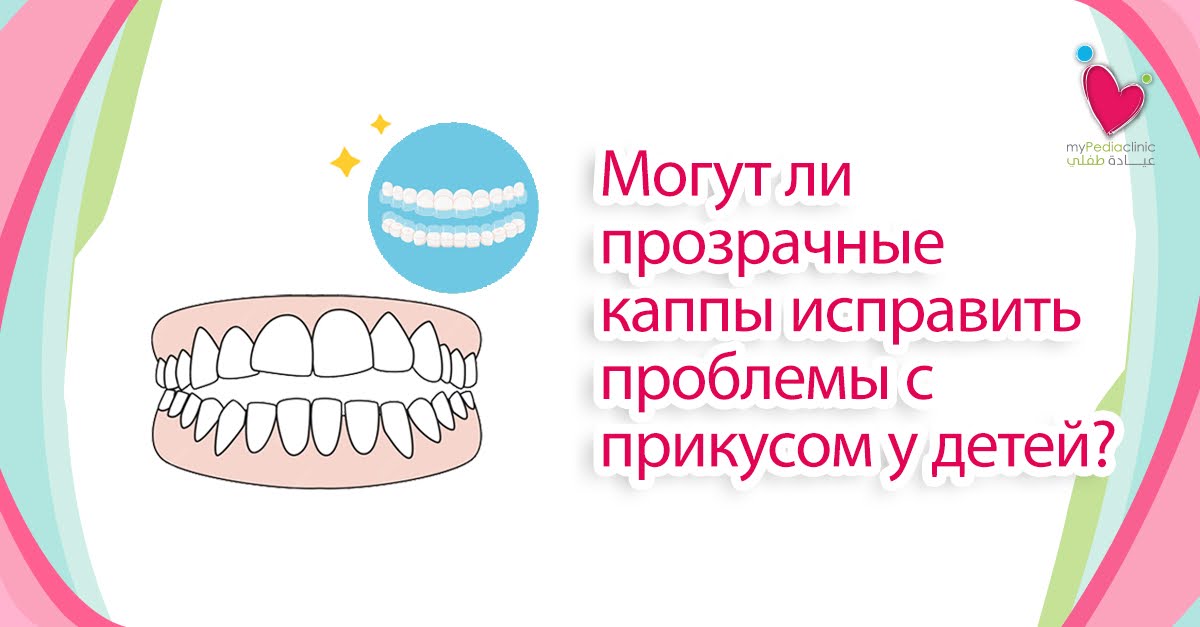 Могут ли прозрачные каппы исправить проблемы с прикусом у детей?